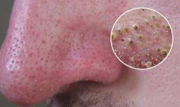 Loại bỏ ngay mụn đầu đen trên mũi với 1 phút thực hiện