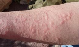 7 dấu hiệu có quá nhiều độc tố trong cơ thể