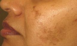 Loại bỏ làn da nám sạm thâm với 2 thành phần dễ tìm