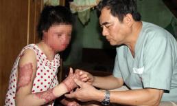 Cô gái bị chồng tưới xăng đốt có hy vọng phục hồi đôi tay