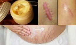 Làm mờ hẳn vết sẹo và rạn da chỉ trong 2 tuần