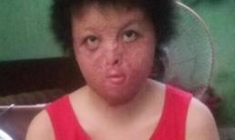 Hoa khôi bị chồng tưới xăng đốt nuôi hy vọng làm lại cuộc đời