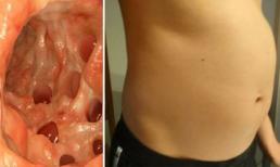 Dạ dày phình, đầy hơi: Dấu hiệu cảnh báo không nên bỏ qua