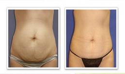 Loại bỏ mỡ bụng, chỉ với hành tây và dưa chuột...