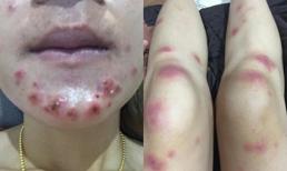 Tiêm thuốc làm trắng da rởm, cô gái phải chịu hậu quả như này