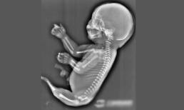 Siêu âm phát hiện thai nhi hình người cá