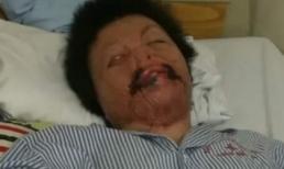 Người vợ bị chồng tẩm xăng đốt chạnh lòng thấy con sợ nhìn thấy mẹ