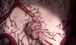 Tế bào ung thư lây lan khắp cơ thể theo cách đáng sợ như thế nào?