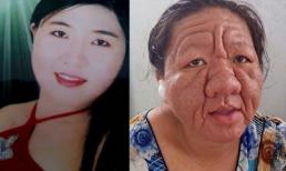 Những nạn nhân thảm thương của corticoid