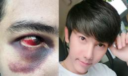 Hotboy bị tụ huyết sưng phù mắt vì phẫu thuật thẩm mỹ ở trung tâm dởm