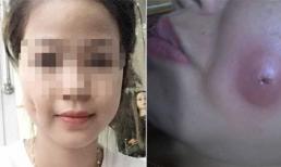 Ham làm má lúm đồng tiền giá rẻ nhiều chị em mặt bị sưng vù