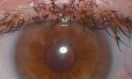 Những điều kinh khủng về chấy rận mà bạn không hề biết