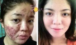 Da không tỳ vết đến 100% với phương pháp thay da sinh học