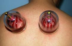 Lợi ích bất ngờ của việc giác hơi