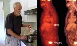 Xóa sổ ung thư giai đoạn 4 bằng baking soda và mật mía