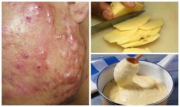 1 củ khoai tây, 3 công thức trị mụn siêu tốc, cứ làm là hiệu quả
