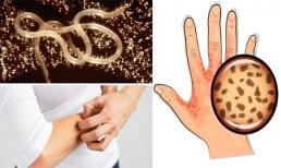 Nếu cơ thể có dấu hiệu này chứng tỏ bạn đang bị kí sinh trùng tấn công