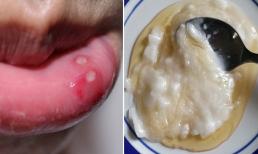 Cách chữa nhiệt miệng bằng 8 biện pháp hoàn toàn tự nhiên cực hiệu quả