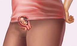 Bạn đã mang thai nếu có những dấu hiệu này sau một tuần quan hệ