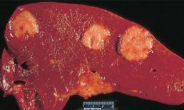 6 KHÔNG để ngăn ngừa ung thư gan