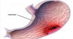 Nhiều người chết oan sớm vì không biết những dấu hiệu sớm này của ung thư dạ dày 