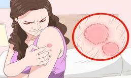 Cách phòng ngừa và điều trị bệnh nấm da hiệu quả