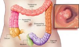 7 dấu hiệu sớm của bệnh ung thư hậu môn, nếu có hãy khám ngay
