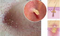 Mụn đầu đen ở mũi tự khắc chui ra chỉ từ hỗn hợp sau