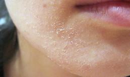 5 cách 'cứu' làn da khô nứt, ngứa, nhiều nếp nhăn trong mùa đông