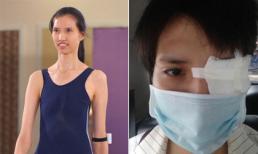 Người mẫu cao nhất Việt Nam Hồng Xuân nhập viện vì mất thị lực