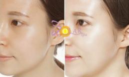 Phun trắng vi kim da 1 liệu trình duy nhất