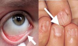 Cảnh báo: Nếu chị em có những triệu chứng này, cơ thể đang thiếu sắt trầm trọng