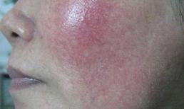 3 sai lầm khi trị nám da sau sinh