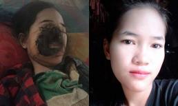 Hãi hùng cô gái bị vi khuẩn ăn nát mặt sau khi nhổ răng