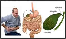 Bật mí công thức loại bỏ sỏi mật trong 7 ngày của người Trung Quốc