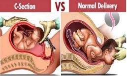 Lợi - hại của sinh thường và sinh mổ các mẹ nên biết