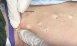 Clip tiết lộ cảnh nặn mụn trứng cá kinh hoàng