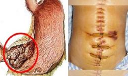 5 dấu hiệu trước khi bị ung thư dạ dày bạn buộc phải biết, chậm là hối tiếc cả đời