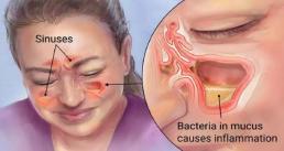 Chữa triệu chứng viêm xoang chỉ trong 20 giây với loại nước tự pha không cần thuốc