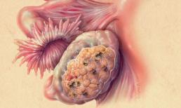 Cách phòng chống 13 loại ung thư phổ biến nhất, ai cũng nên biết để tự cứu mình