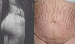 Ám ảnh với những khoảnh khắc bị rạn da của phụ nữ sau sinh