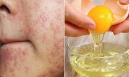 Cách chữa dị ứng da mặt với lòng trắng trứng gà hiệu quả đến bất ngờ