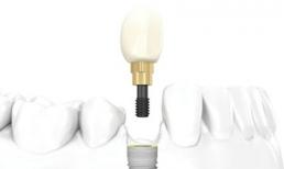 Công nghệ cấy ghép Implant ETK Active lên răng tức thì