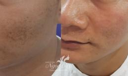 Hết sẹo không khó