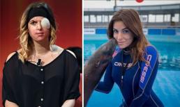 Sốc với  gương mặt bị hủy hoại của thí sinh Hoa hậu Ý do bạn trai cũ tạt axit