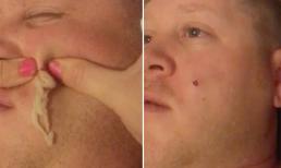 Rùng mình cảnh vợ nặn mụn khổng lồ 4 năm nằm trên mặt chồng