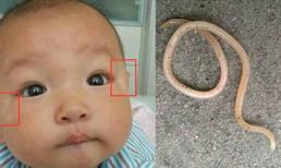 Cha mẹ bỏ bê để rồi 'tá hỏa' khi phát hiện giun tròn khổng lồ trong bụng bé