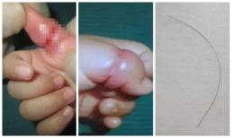 Bé gái 5 tháng tuổi suýt phải cắt bỏ ngón tay vì thói quen hàng ngày của mẹ trẻ