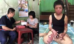 Chí Trung xót xa trước dung nhan của 'Hoa hậu' Thùy Dung sau khi bị chồng đổ xăng châm lửa đốt