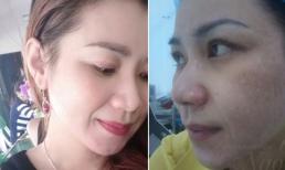 Thoát ám ảnh nám da sau 6 năm chữa trị